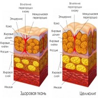 Целлюлит (гиноидная липодистрофия) или "апельсиновая корка".